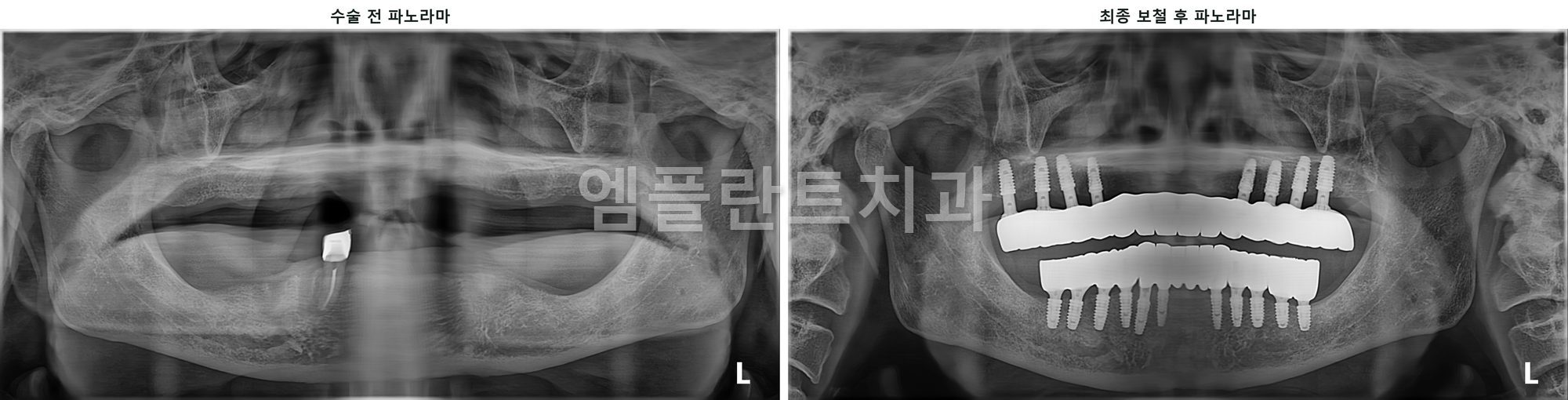 수술 전 파노라마와 풀아치 임플란트 최종 보철 후 파노라마 비교