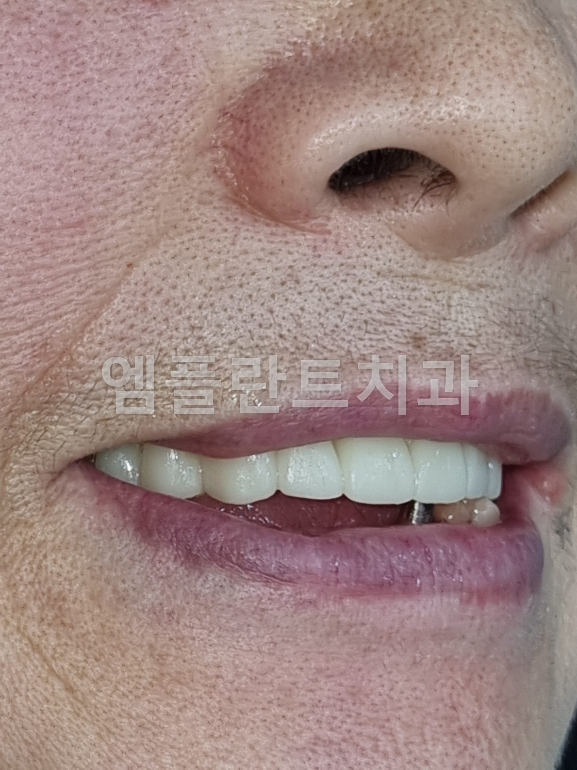 수술 엿새 뒤 임시치아를 끼고 웃는 입가