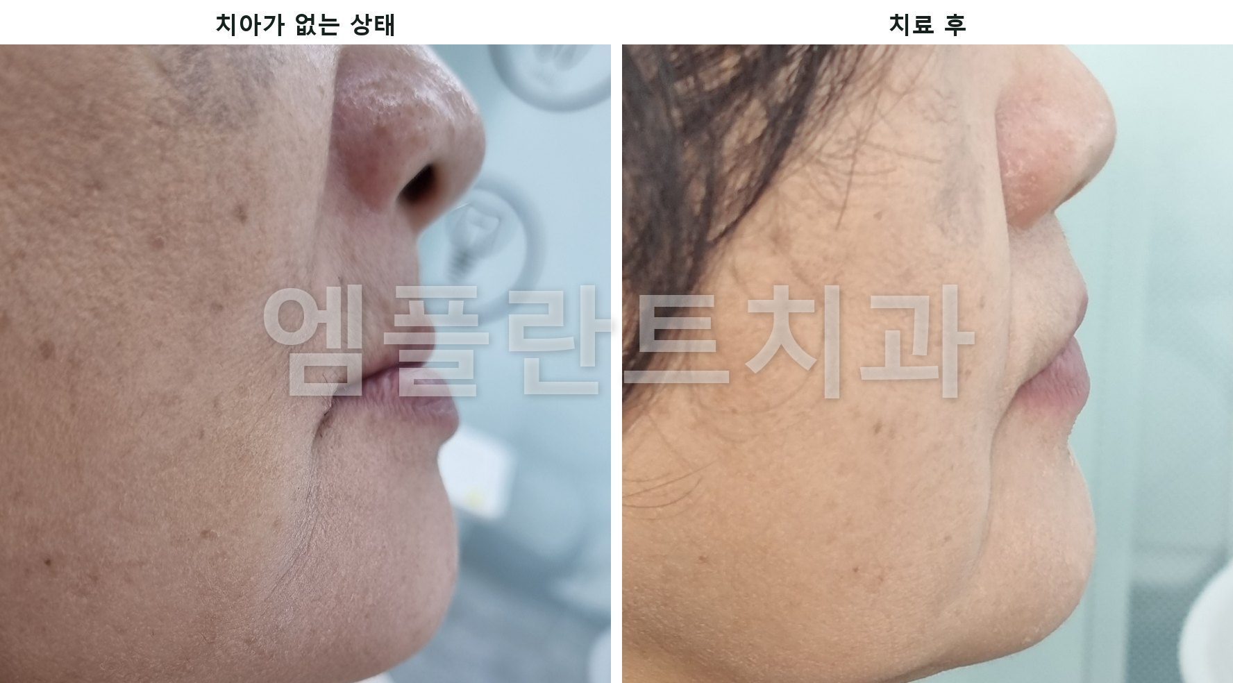 치아가 없을 때 안으로 말려 들어간 윗입술과 치료 후 앞으로 나온 윗입술을 옆에서 비교한 사진